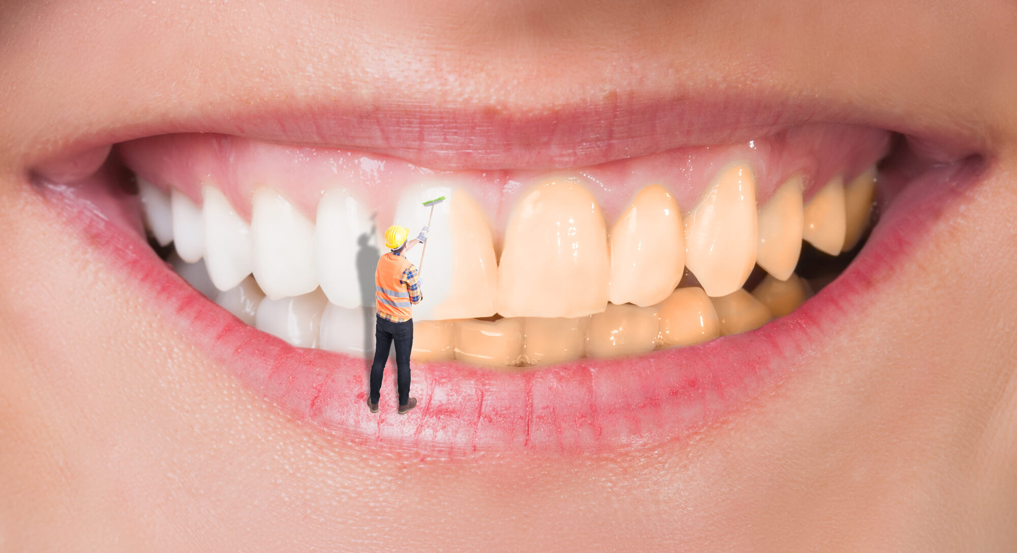 Illustration of Teeth Whitening in Boca Raton