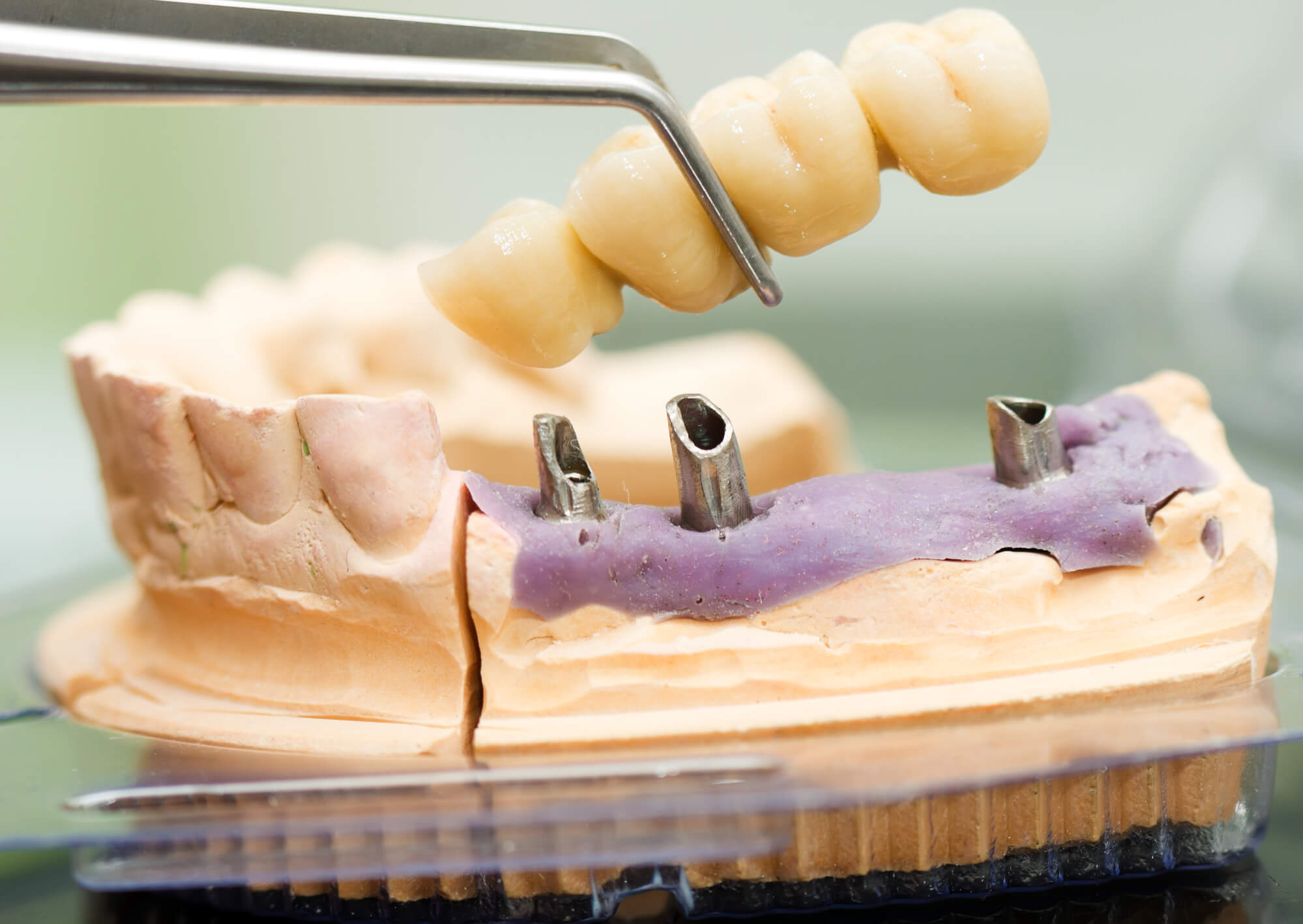 Dental Implants in Boca Raton and dental bridge