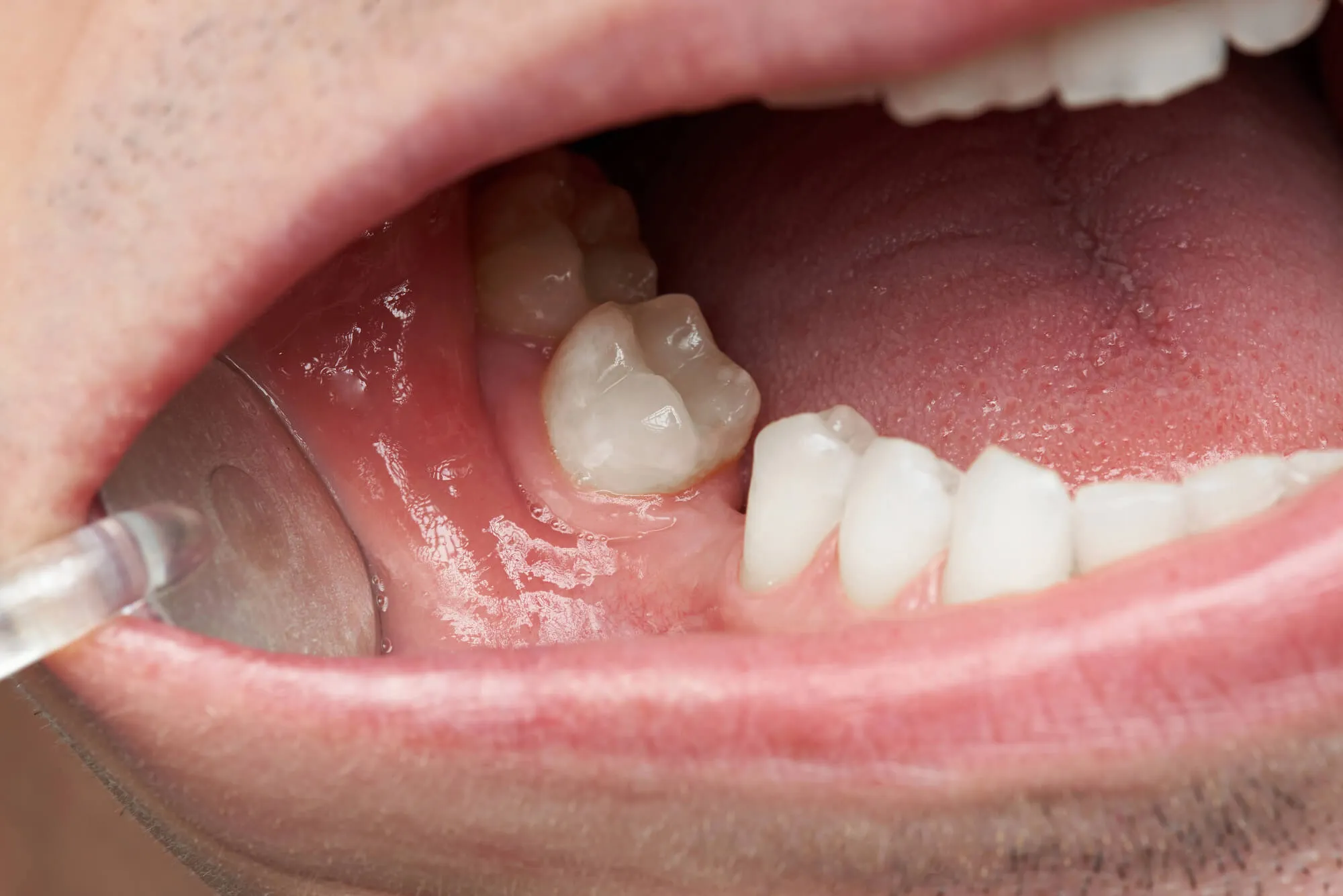 man-with-missing-tooth-needs-dentures-boca-raton