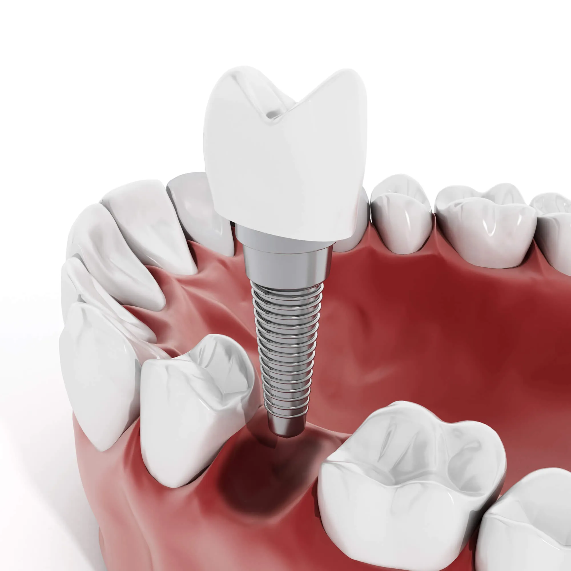 dental-implants-boca-raton-illustration