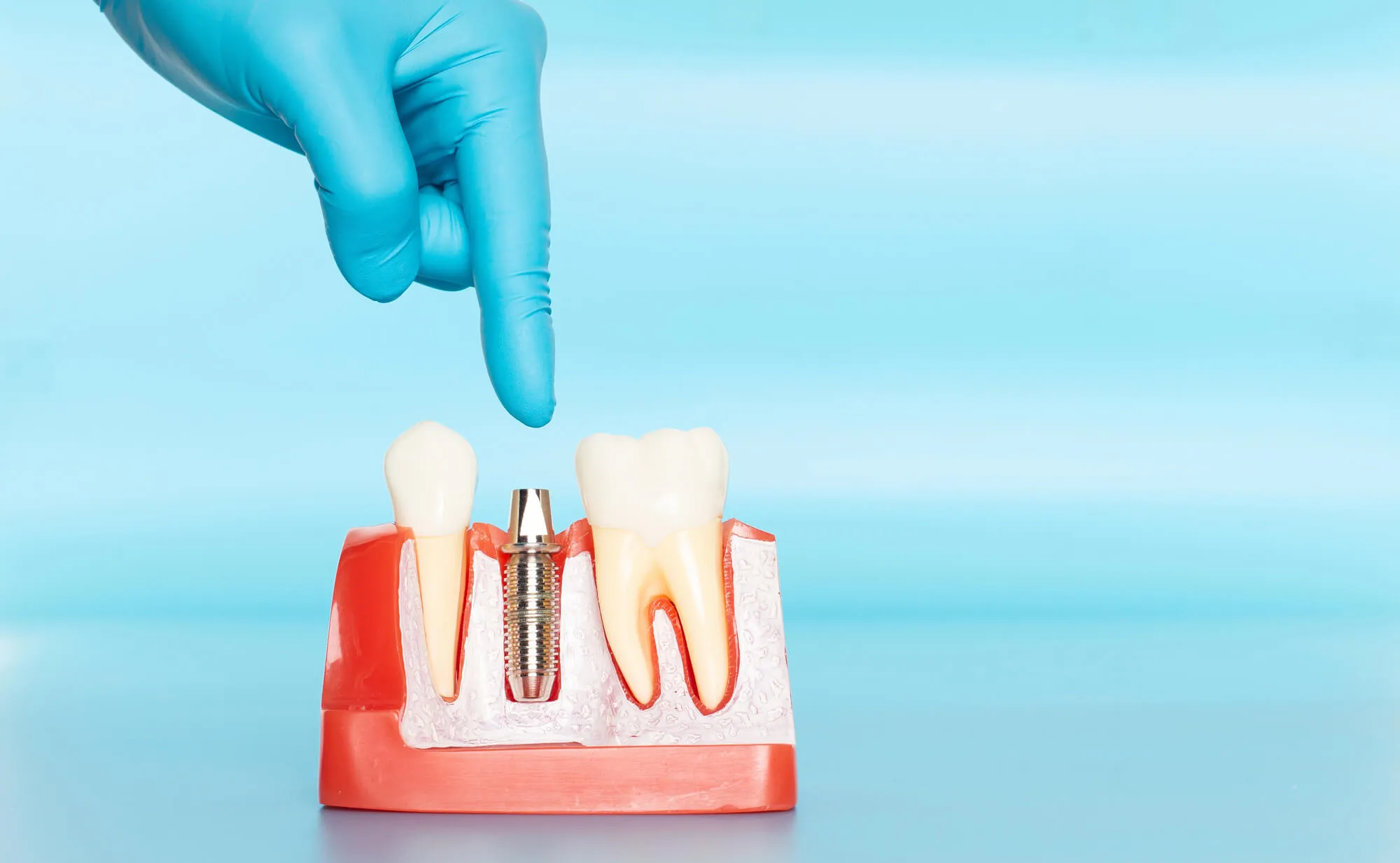 dental-implants-boca-raton-model