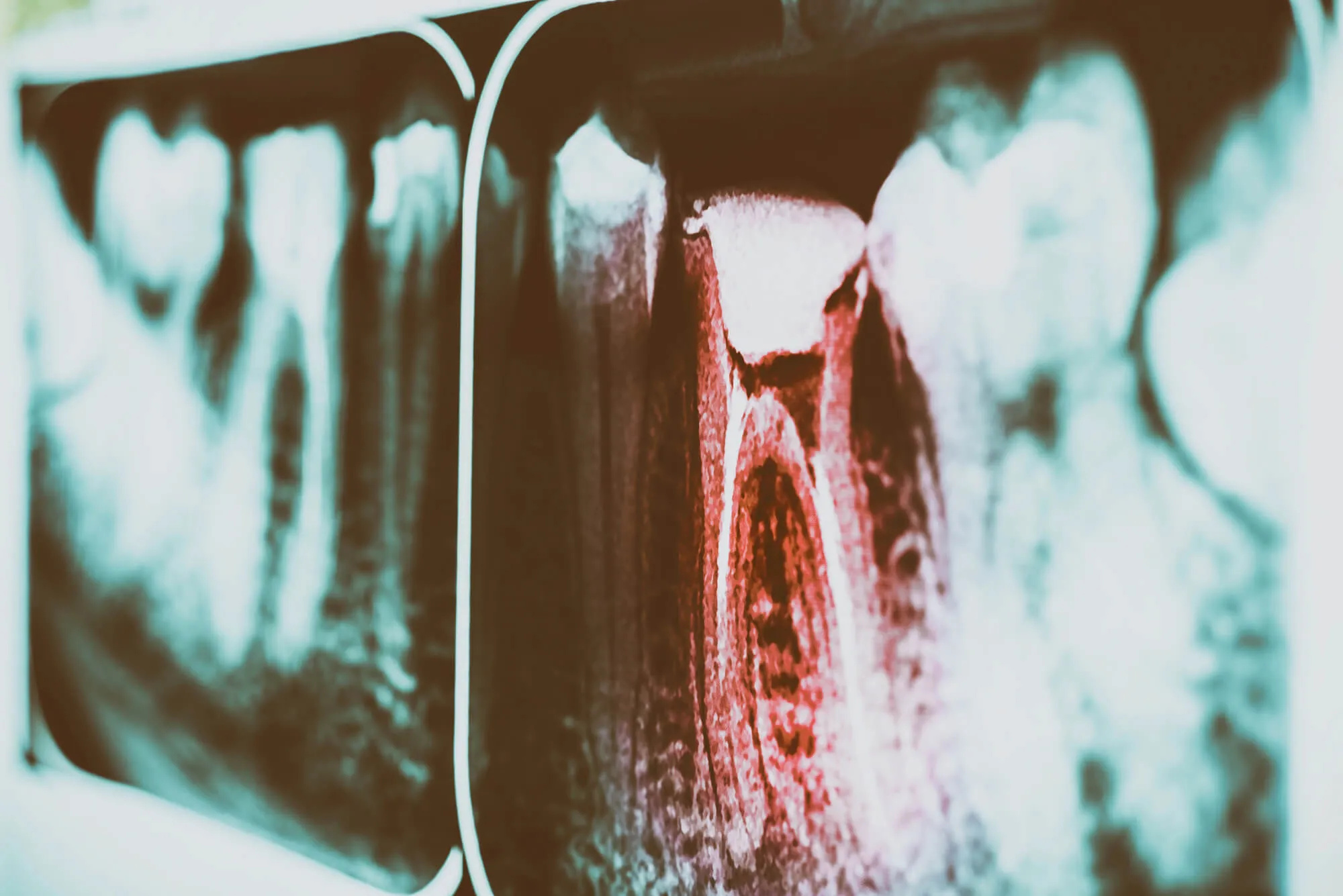 emergency dentist boca raton looking at an Xray image