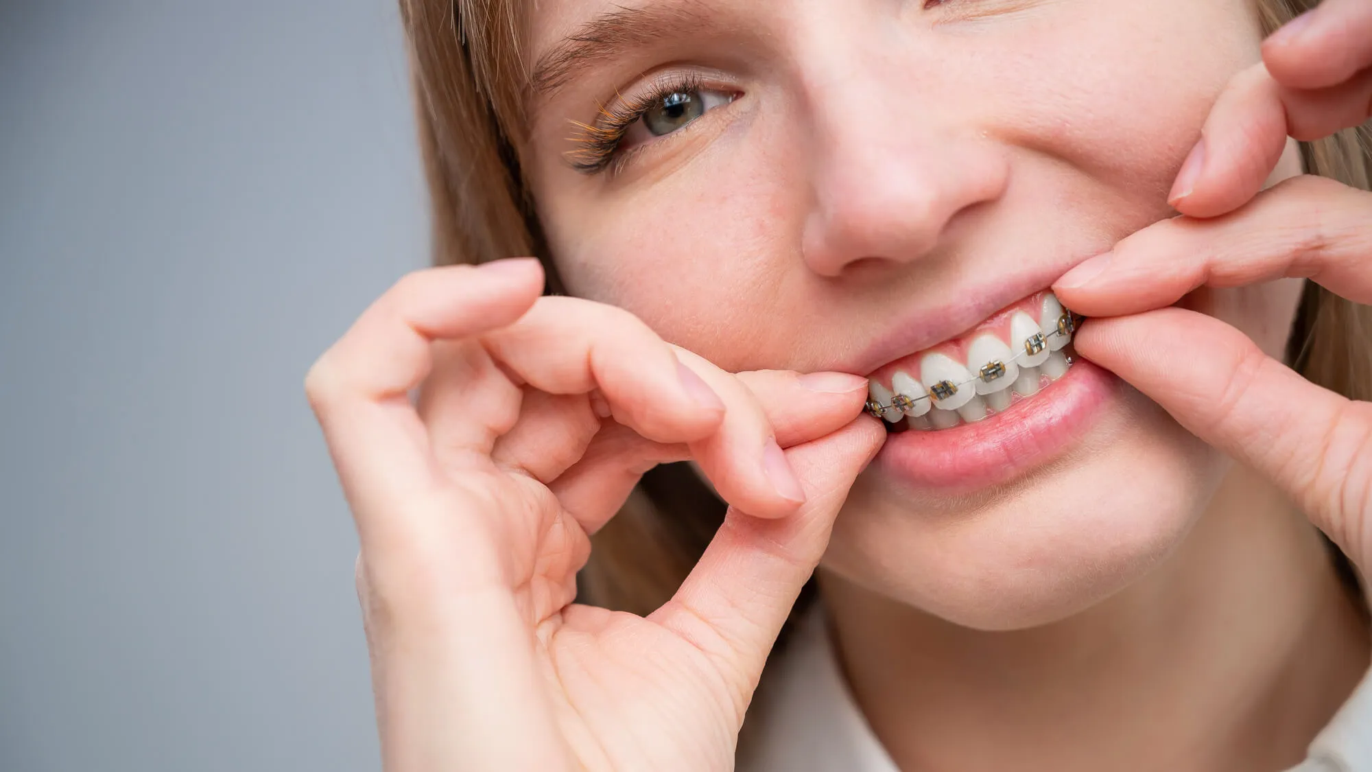 patient chose braces over invisalign boca raton