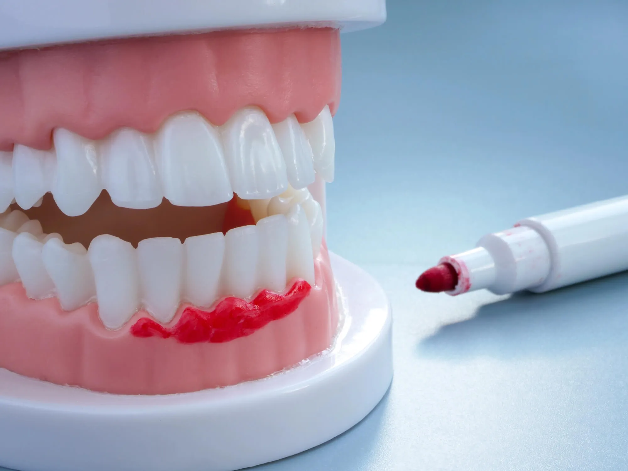 Dentist near FAU shows a sample of gum disease on a teeth model