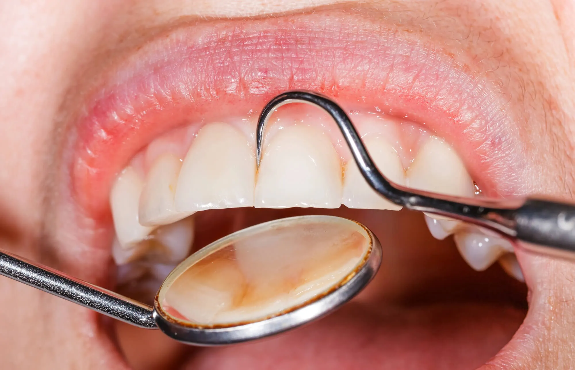 periodontist-boca-raton-cleaning-teeth